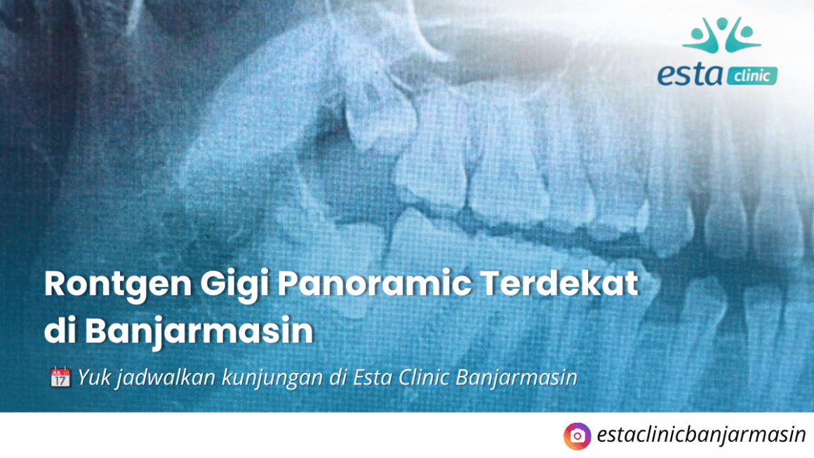 Rontgen Gigi Panoramic Terdekat di Banjarmasin Rontgen Gigi Panoramic Terdekat di Banjarmasin: Kenapa Perlu & Di Mana Bisa Dilakukan?