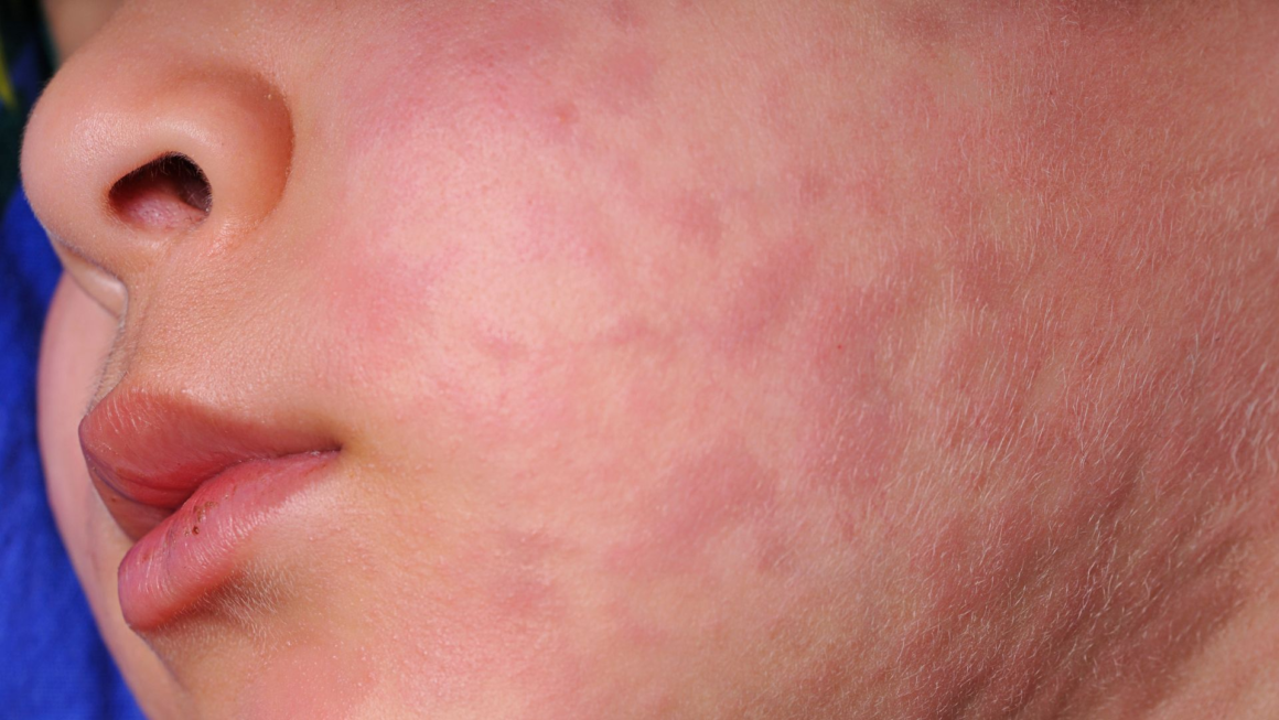 image Kasus Campak Meningkat 2026: Pentingnya Vaksin Campak di Banjarmasin