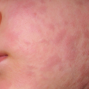 Kasus Campak Meningkat 2026: Pentingnya Vaksin Campak di Banjarmasin