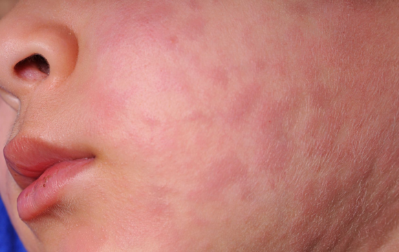 image Kasus Campak Meningkat 2026: Pentingnya Vaksin Campak di Banjarmasin